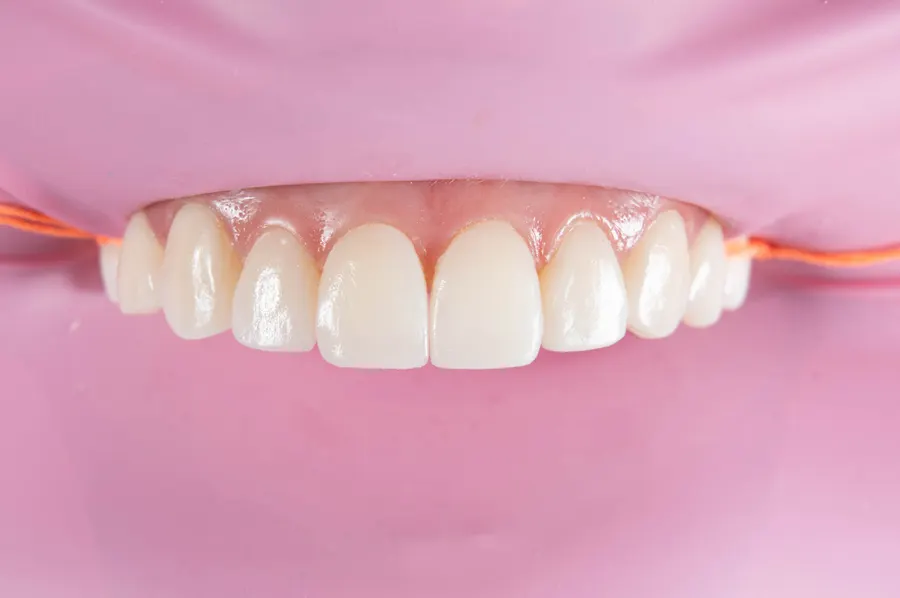 Diseño de sonrisa con carillas — proceso