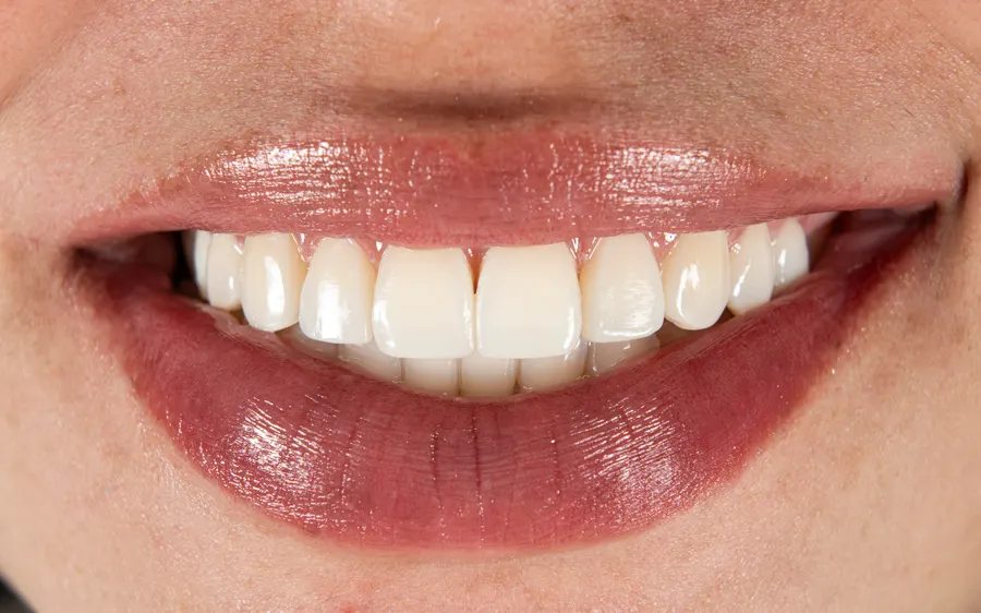 Resultado carillas cerámicas — odontología estética Bogotá