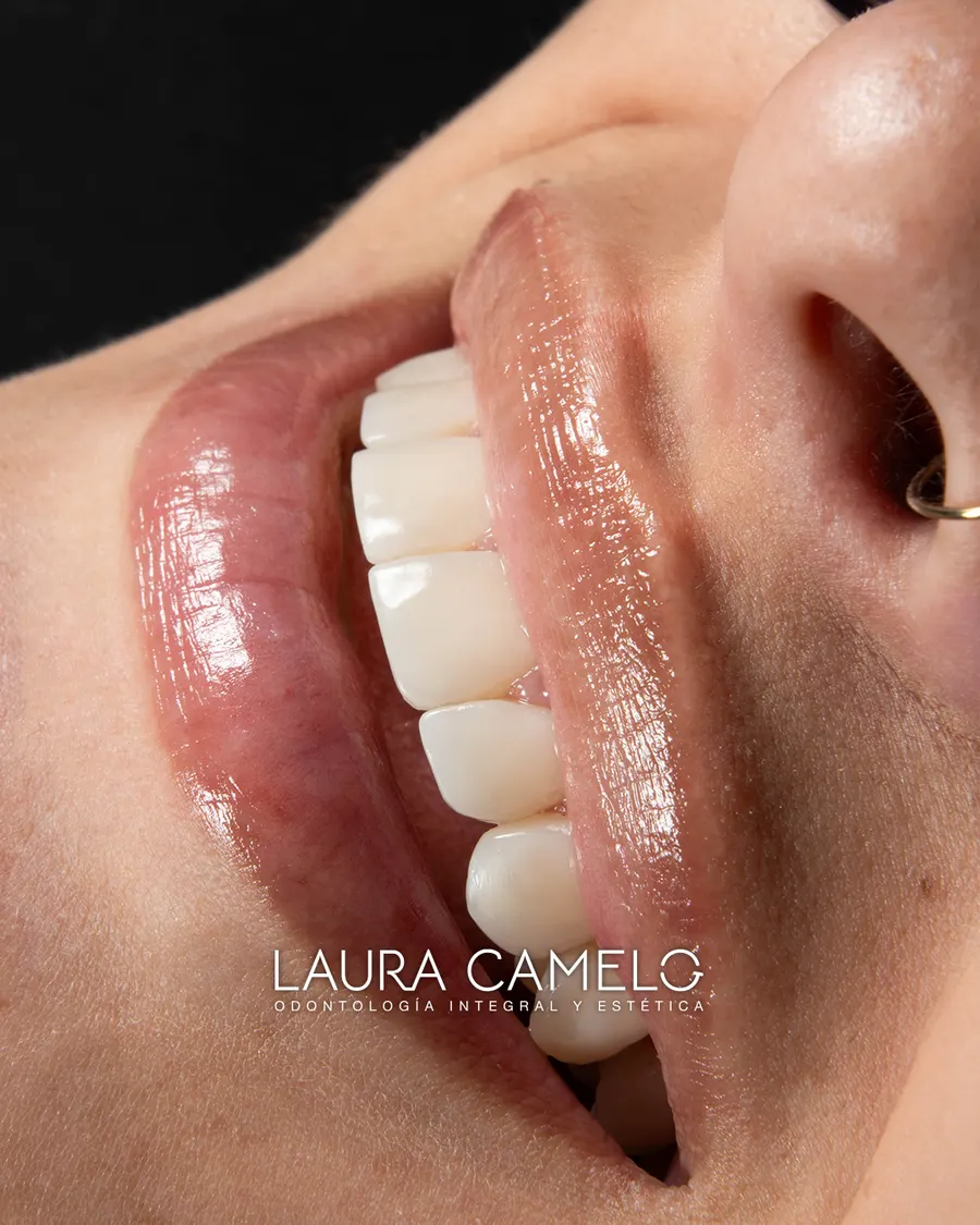 Diseño de sonrisa — antes del tratamiento odontológico
