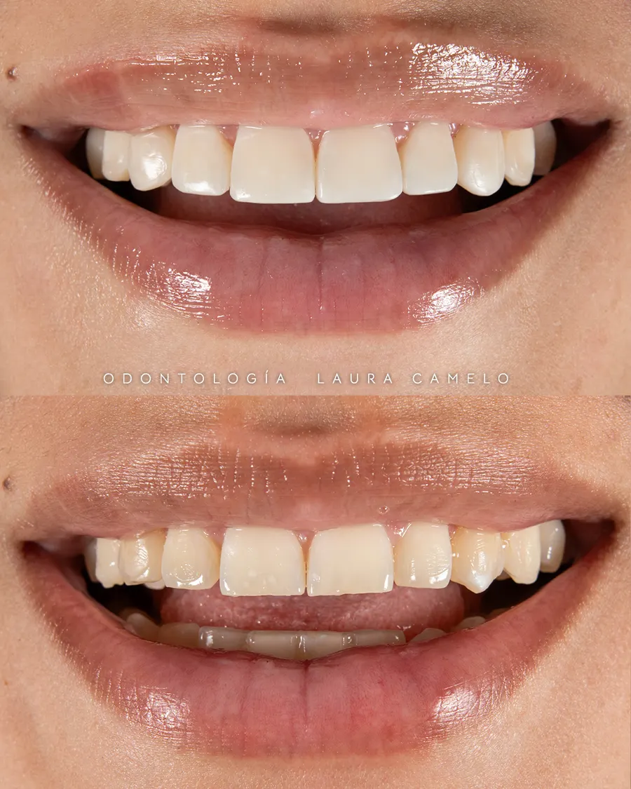 Diseño de sonrisa Bogotá — resultado con armonía facial