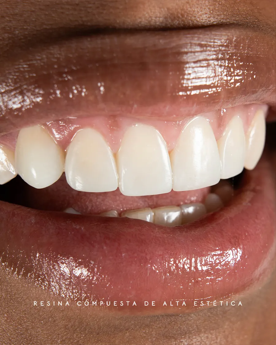 Coronas dentales — resultado rehabilitación integral