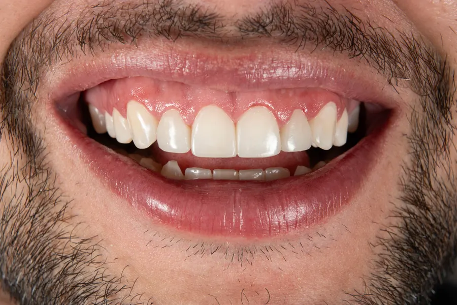 Blanqueamiento dental — antes del tratamiento