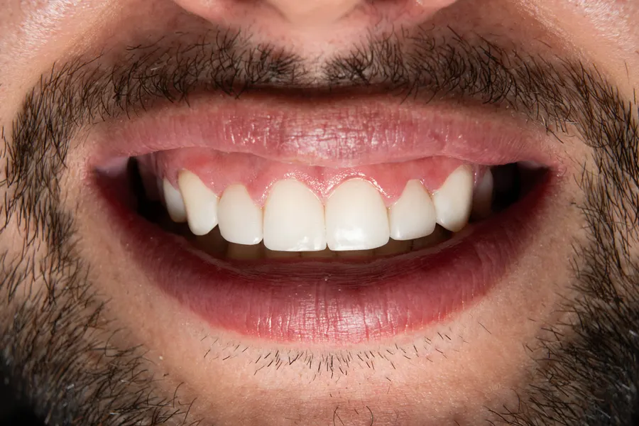 Dientes blancos — resultado aclaramiento dental Bogotá