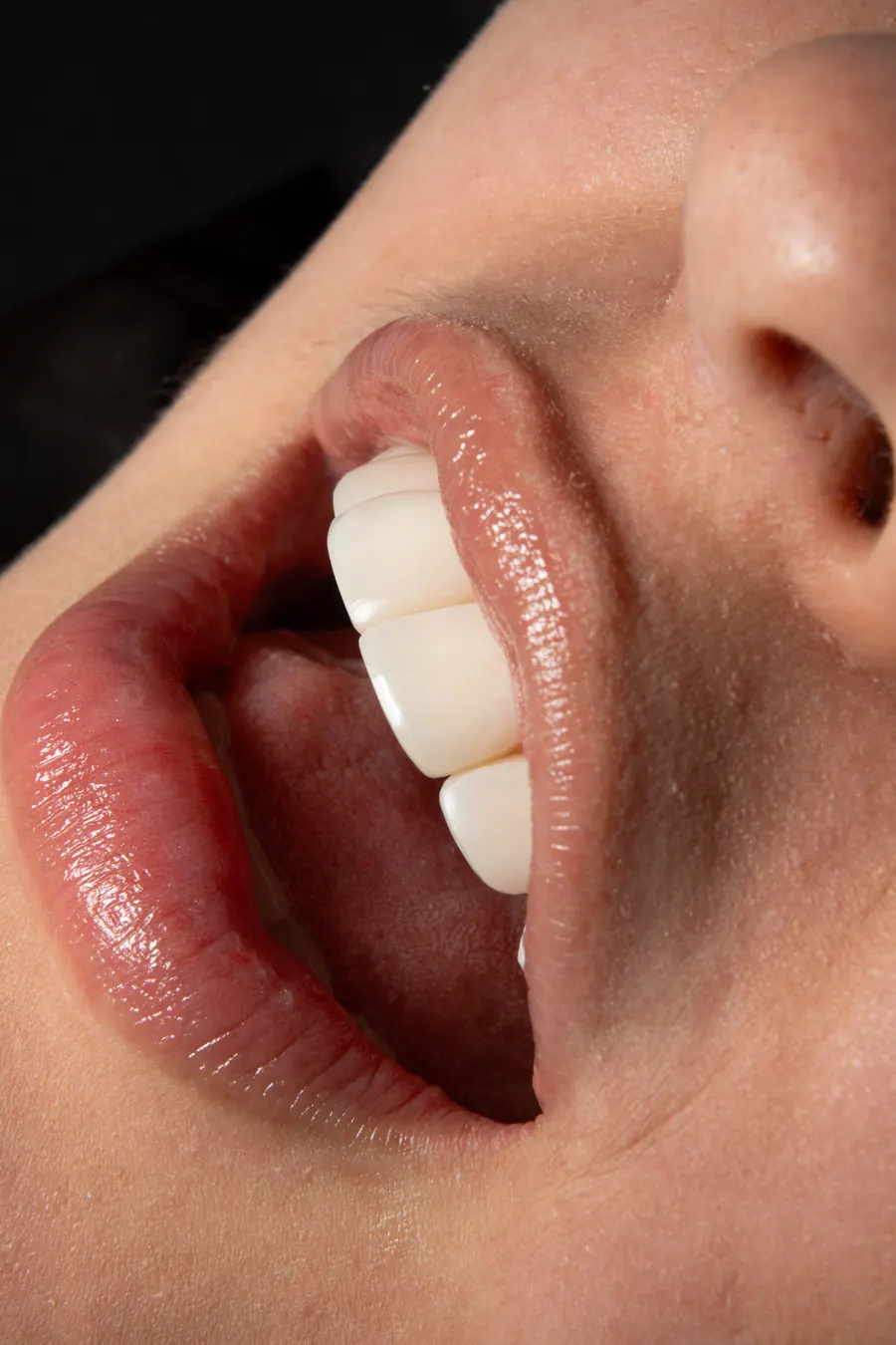 Sonrisa lateral — resultado odontología estética Bogotá