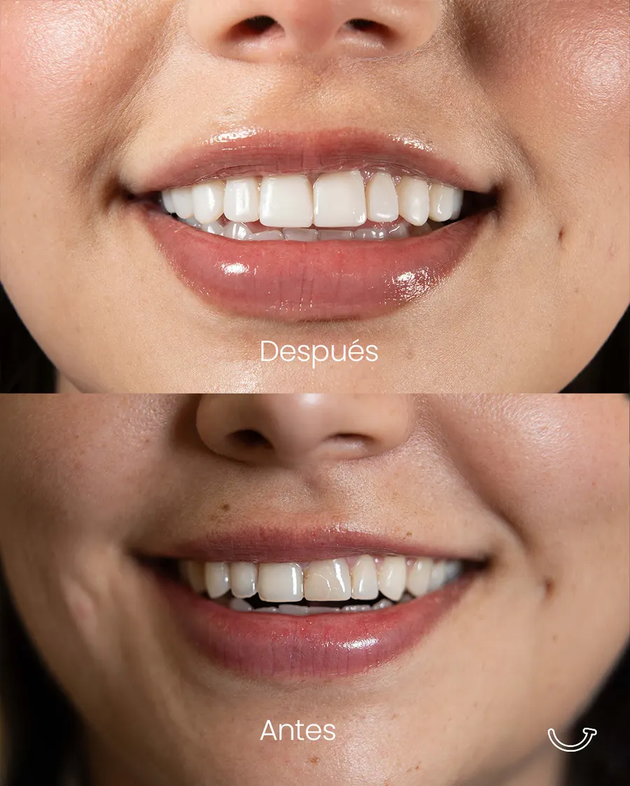 Antes y después lentes cerámicos — Laura Camelo Bogotá
