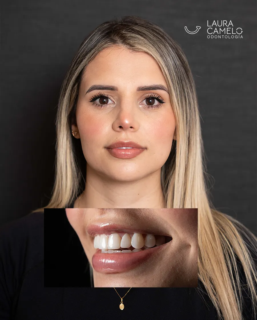 Lentes cerámicos antes y después — transformación de sonrisa