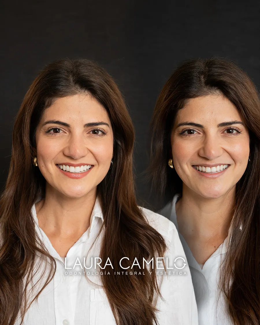 Diseño de sonrisa — proceso y diagnóstico digital