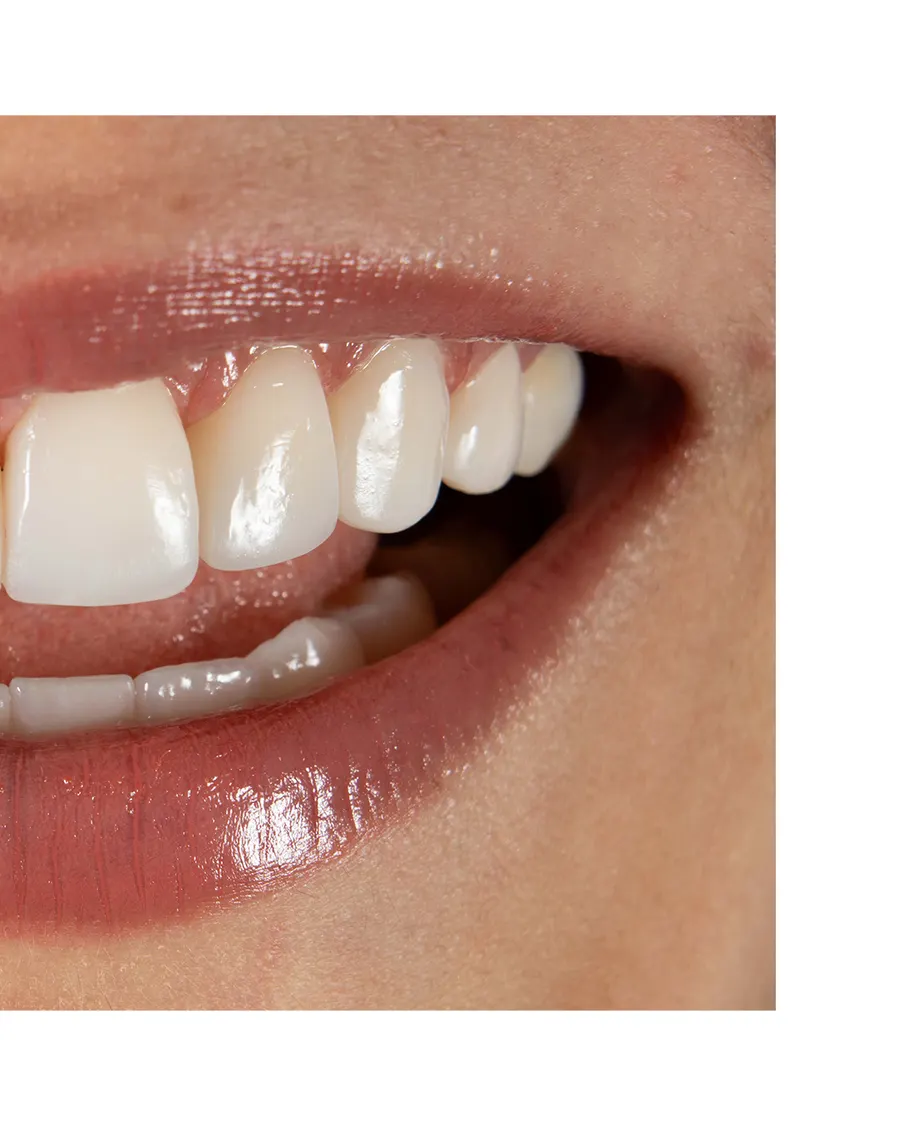 Caso de diseño de sonrisa — detalle dientes