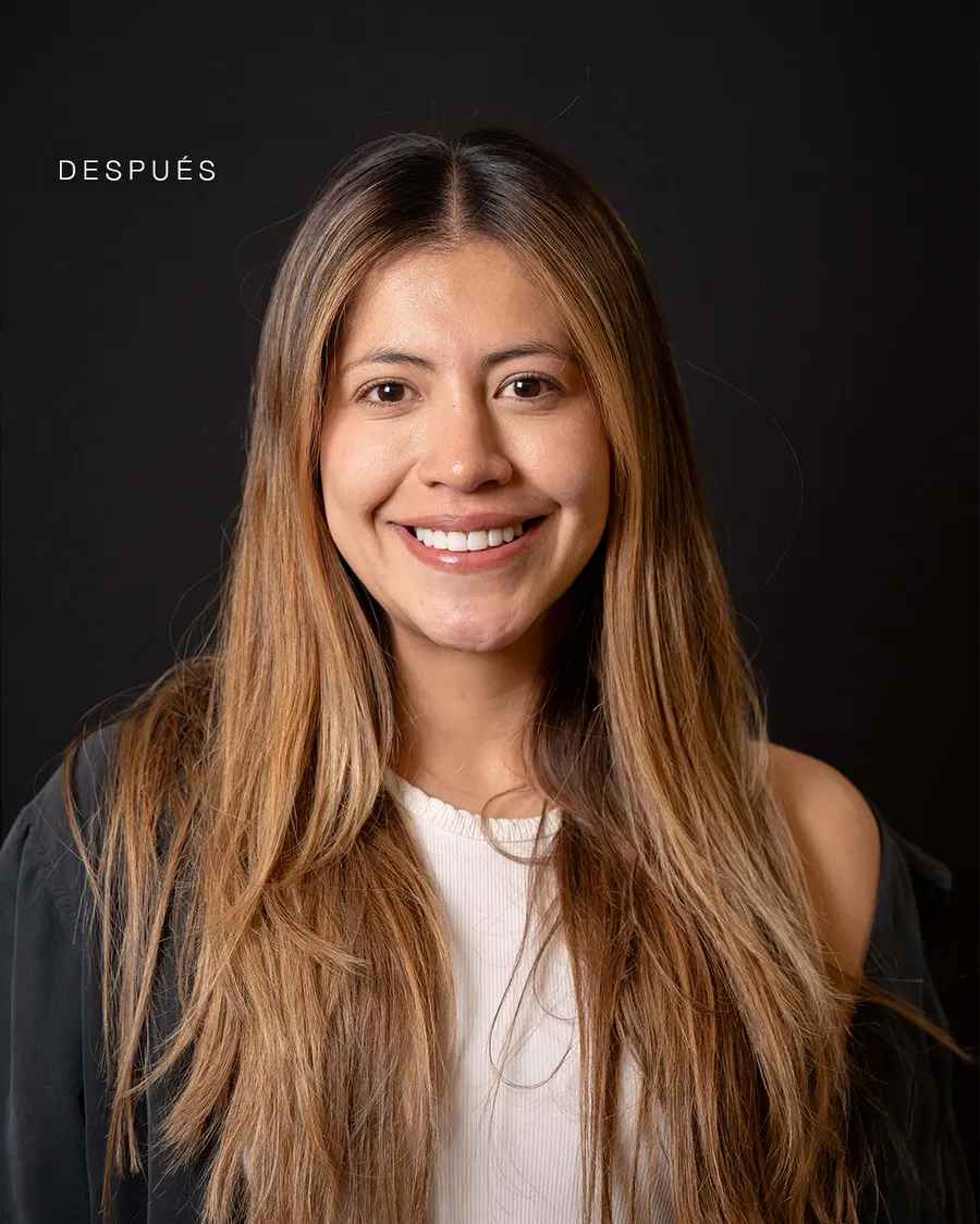 Rehabilitación oral — prótesis dental resultado natural Bogotá
