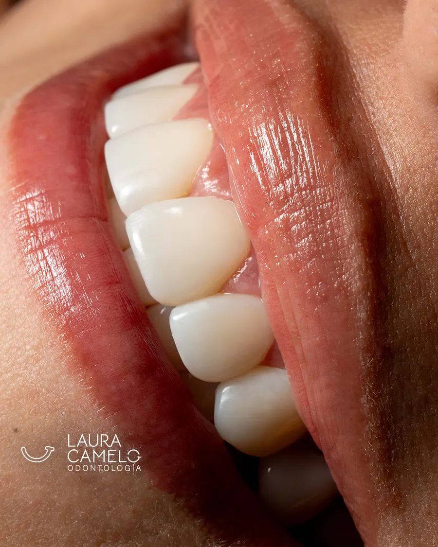 Resultado rehabilitación dental completa — Bogotá Colombia