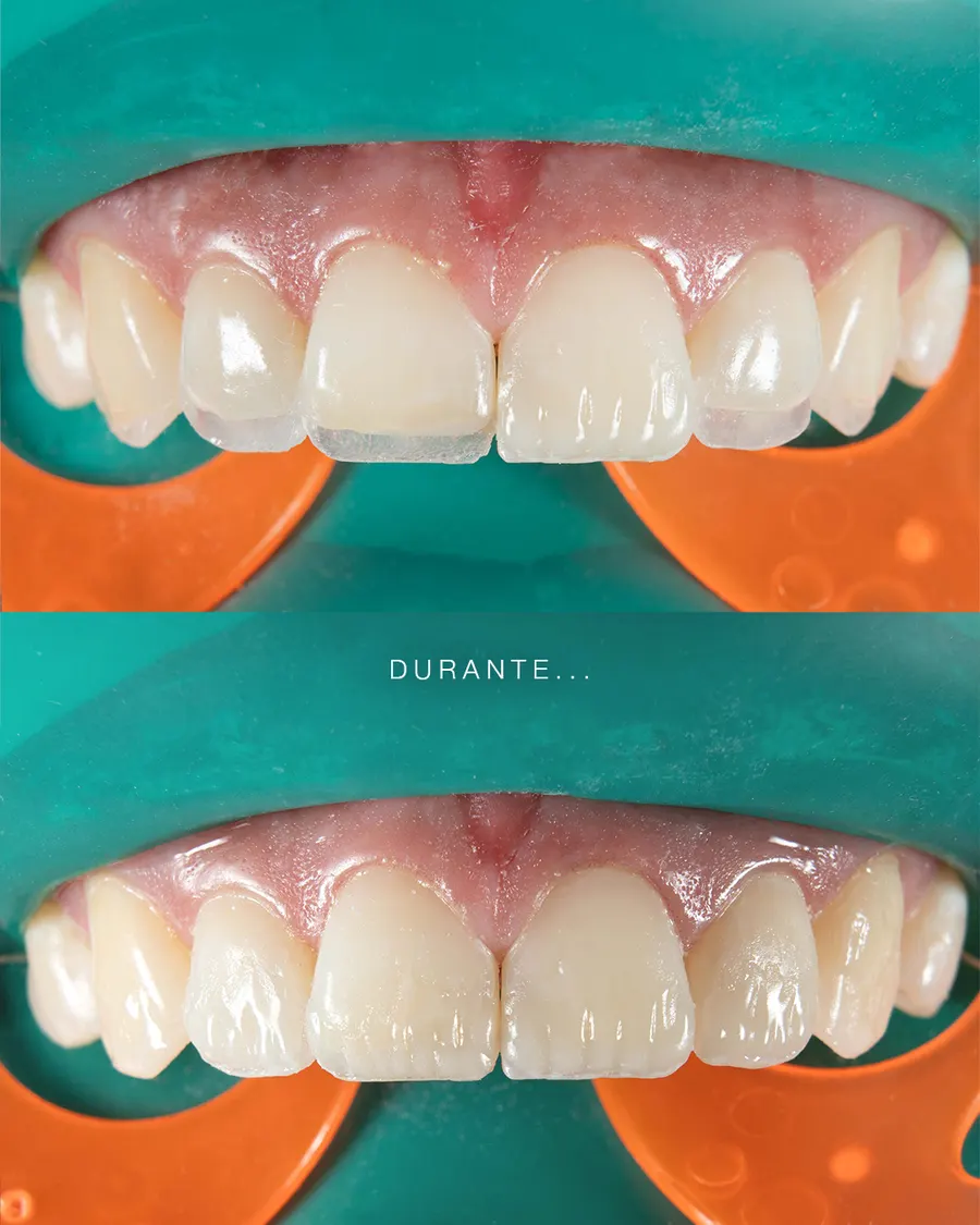 Lentes cerámicos sonrisa natural — Laura Camelo Odontología