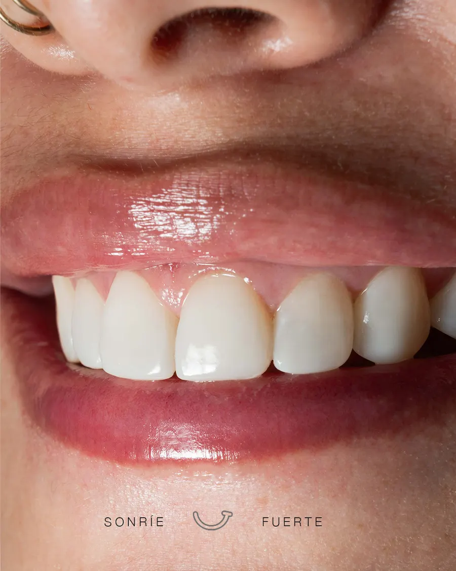 Carillas de porcelana — durabilidad y estética